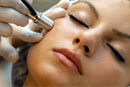 Microdermabrasion